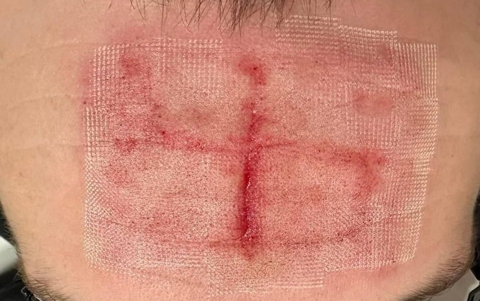 Russian soldiers carved swastikas into the foreheads of two Ukrainian priso<em></em>ners of war, doctors said