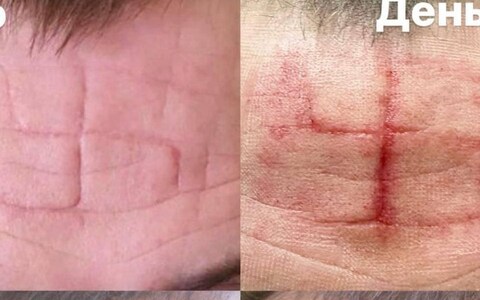 Two soldiers are being treated for swastika-shaped torture scars 