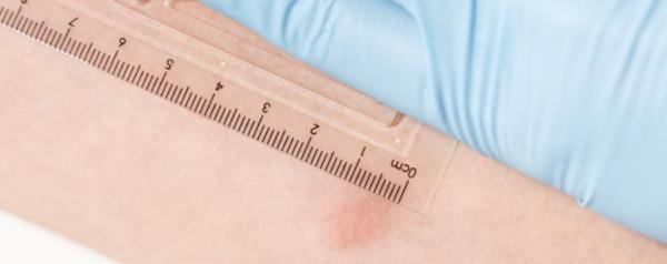 A case of pulmo<em></em>nary tuberculosis reported in a minor in Carpi