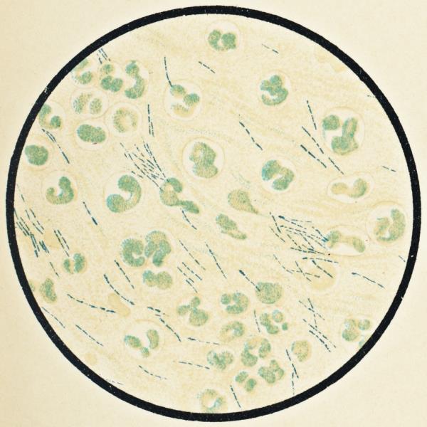 Microscopic view of human white blood cells and burkholderia mallei bacteria from a patient with glanders. 