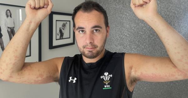 A British builder suffered a horrifying reaction to bedbugs while on holiday in France