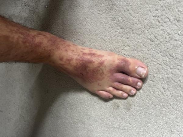 Cory Gardner claims he had severe reaction to bedbug bites after being bitten on holiday in France. Photo released November 12 2023. See SWNS story SWSYbugs. A British builder suffered a horrifying reaction to bedbugs while on holiday in France, he claims. Cory Gardner, 26, says he was bitten on a two-centre trip to Paris and Lyon. He went away with partner Olivia Wood, 25, in September and returned without incident. But days after arriving back at home in Bridgend he started itching all over.