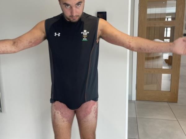 Cory Gardner claims he had severe reaction to bedbug bites after being bitten on holiday in France. Photo released November 12 2023. See SWNS story SWSYbugs. A British builder suffered a horrifying reaction to bedbugs while on holiday in France, he claims. Cory Gardner, 26, says he was bitten on a two-centre trip to Paris and Lyon. He went away with partner Olivia Wood, 25, in September and returned without incident. But days after arriving back at home in Bridgend he started itching all over.