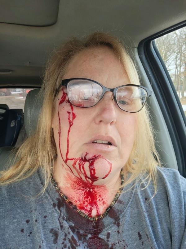 Rho<em></em>nda Stickney shows her bloody injuries after pit bull attack