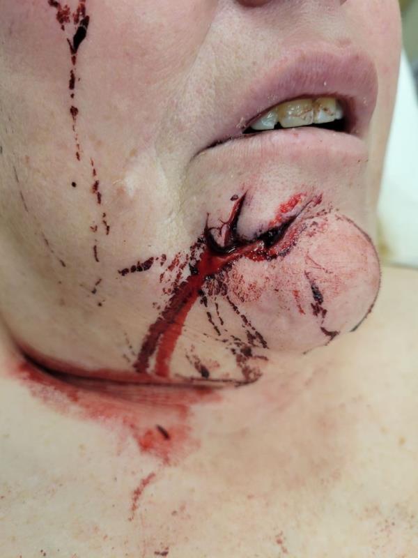 Image shows gash near her chin