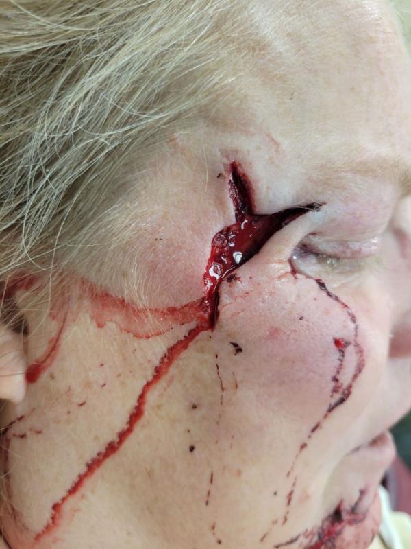 Image shows wound near woman's eye